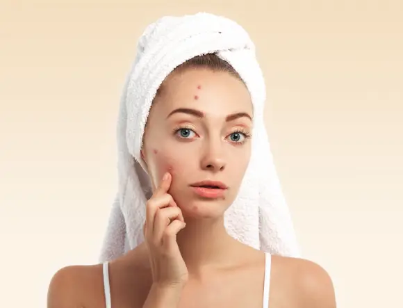 Laser Multi-Depth Fractional Acne Scarring